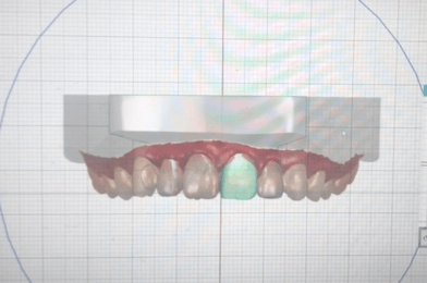 Clear Aligners